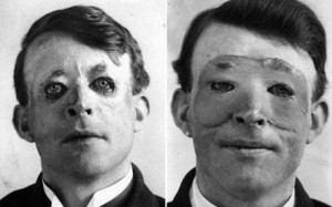 Walter_Yeo_skin_graft